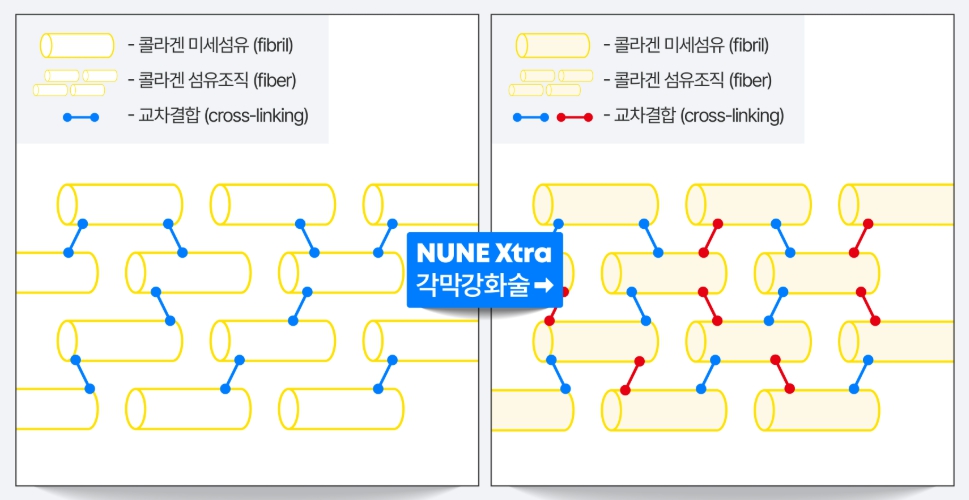 각막두께검사 후 각막 부작용 예방을 위한 대안 중 각막강화술 효과를 설명하는 이미지