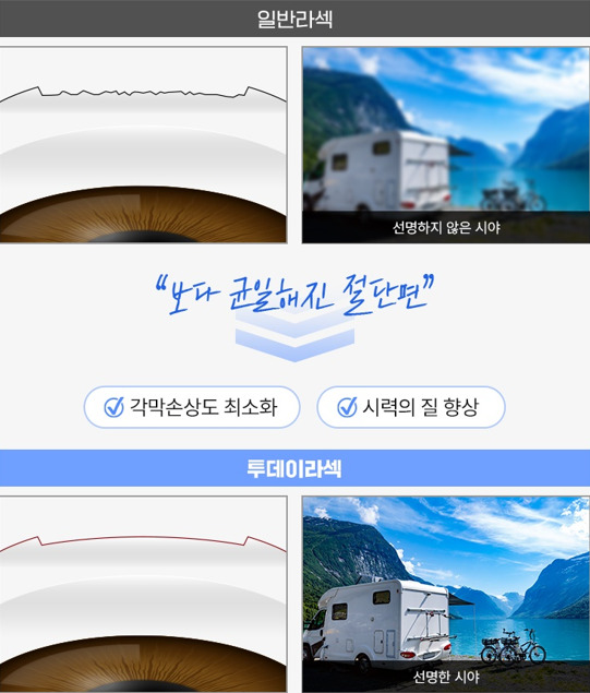 일반라섹과 투데이라섹의 차이를 설명하는 시각적인 보조자료반라섹과 투데이라섹의 차이를 설명하는 시각적인 보조자료