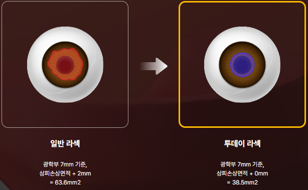 투데이라섹은 일반 라섹보가 각막상피 제거면적을 최소화하여 회복기간에서 차이가 난다는 시각적자
