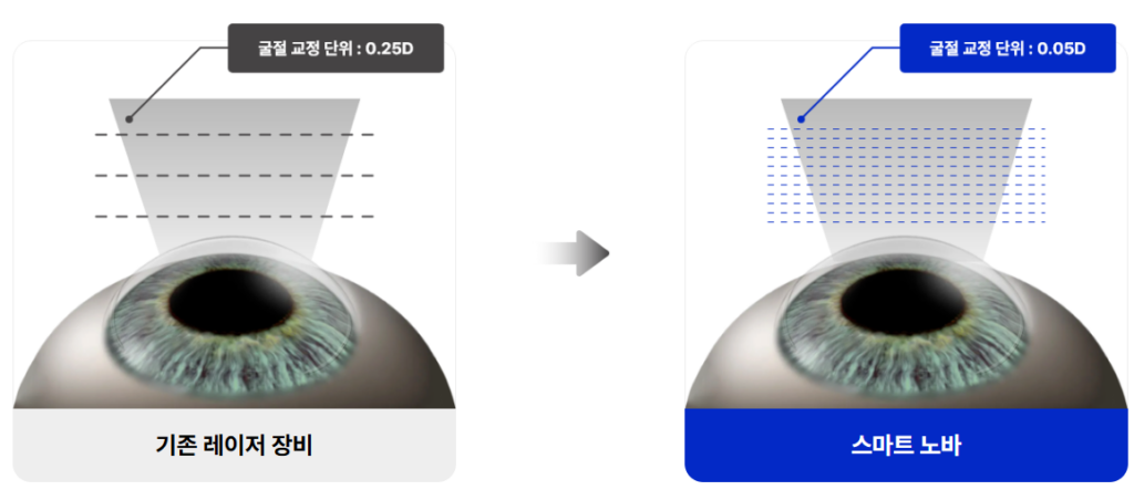 스마트노바라식과 기존 레이저 장비의 굴절 교정 단위의 차이점을 보여주고 있는 이미지