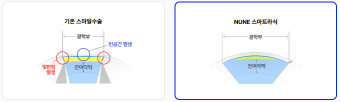 누네안과병원에서 설명하는 스마일라식의 강