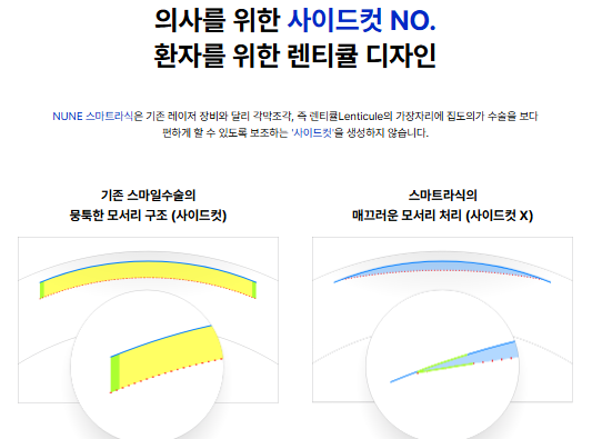 스마트라식의 장점인 기존 레이저 장비와 달리 렌티큘의 가장자리에 집도의가 수술을 보다 편하게 할 수 있는 사이드컷을 생성하지 않는다는 시각적인 보조자료