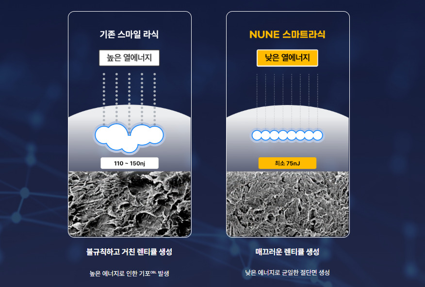 누네인과의 스마트라식수술의 추가적인 장점