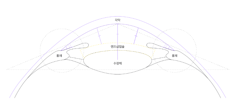 ICL렌즈삽입술가격, 비싸도 선택하는 3가지 이유