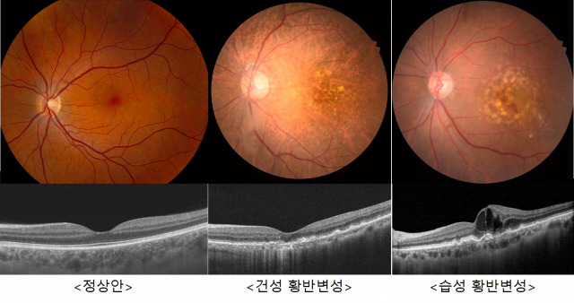 망막질환의 종류 일부분 사진