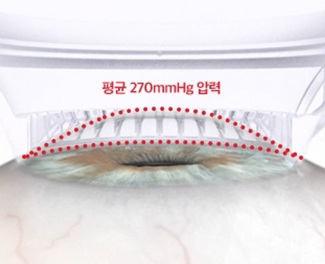 스마트라식시 곡선형안구장치로 인해 각막변형을 최소화한다는 이미지